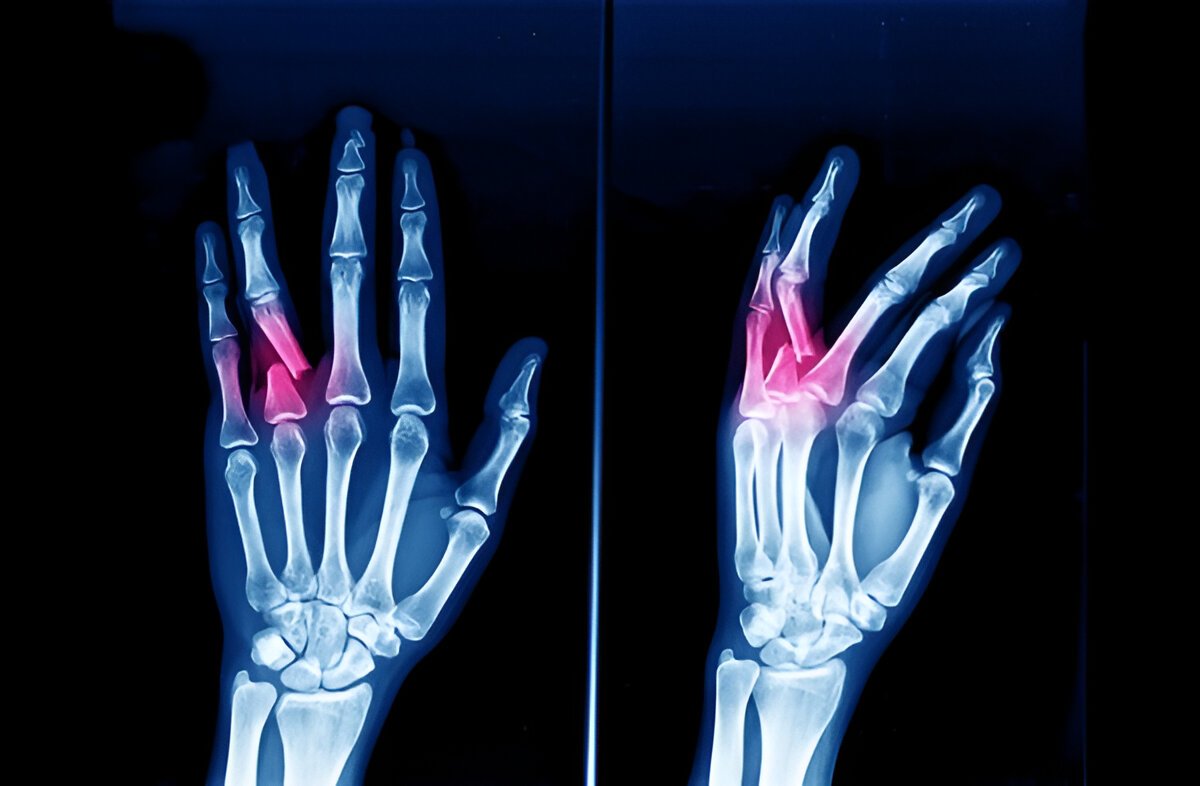 Phalangeal Fracture (Finger Fracture)